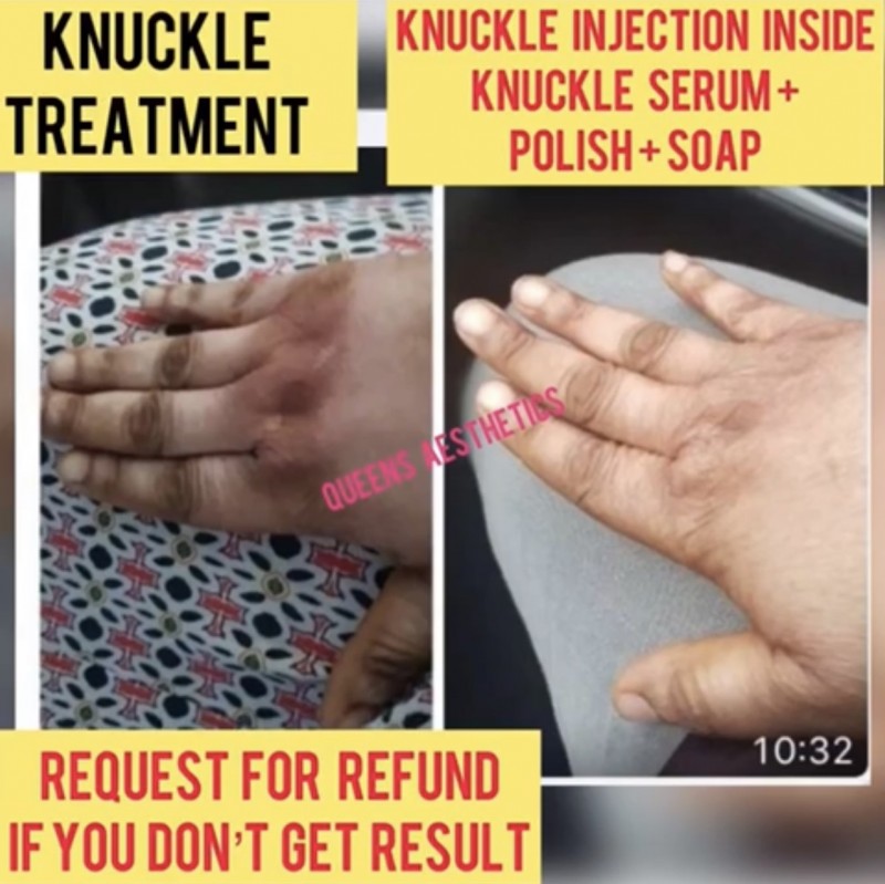 Advance Knuckle Kit