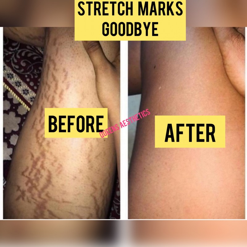 Mini Stretch Mark Kit