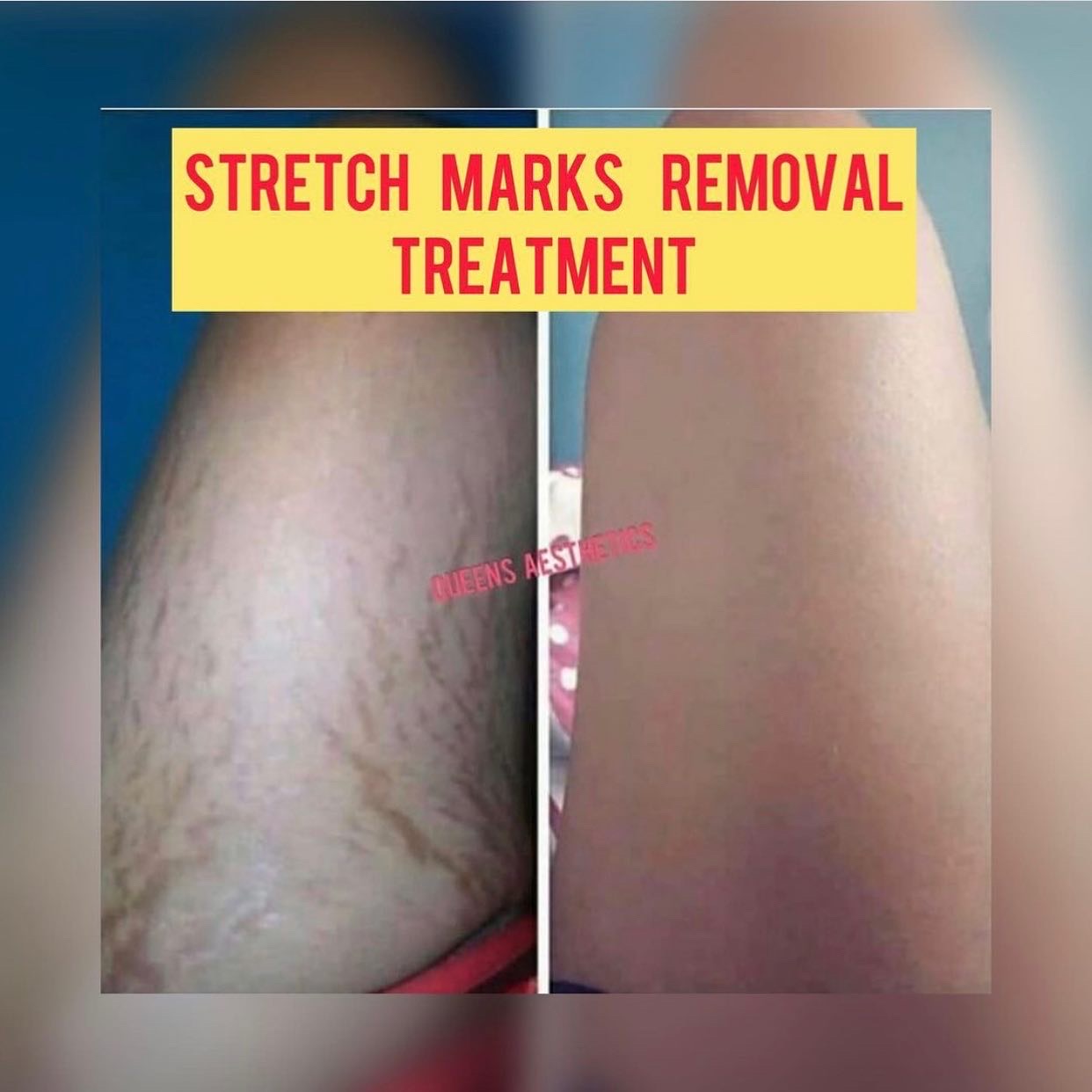 Guaranteed stretch marks Treatment