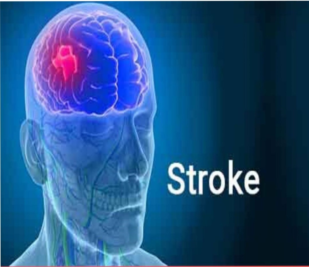 Stroke (Know Your Risk of Having a Brain Attack and How to Prevent It)