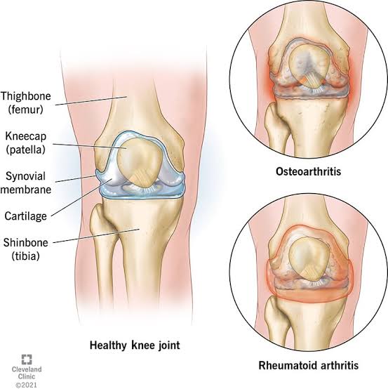Arthritis Herbal Medicine