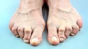 Arthritis Herbal Medicine