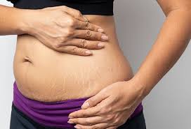 Stretch Marks Removal Cream
