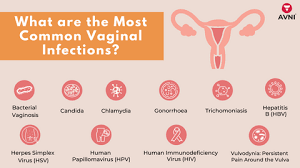 Vaginal infection ( discharge, itching)