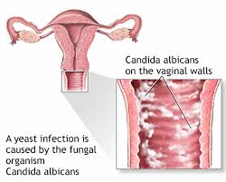 Candida Infections: Clinical Features,  Diagnosis and Treatment