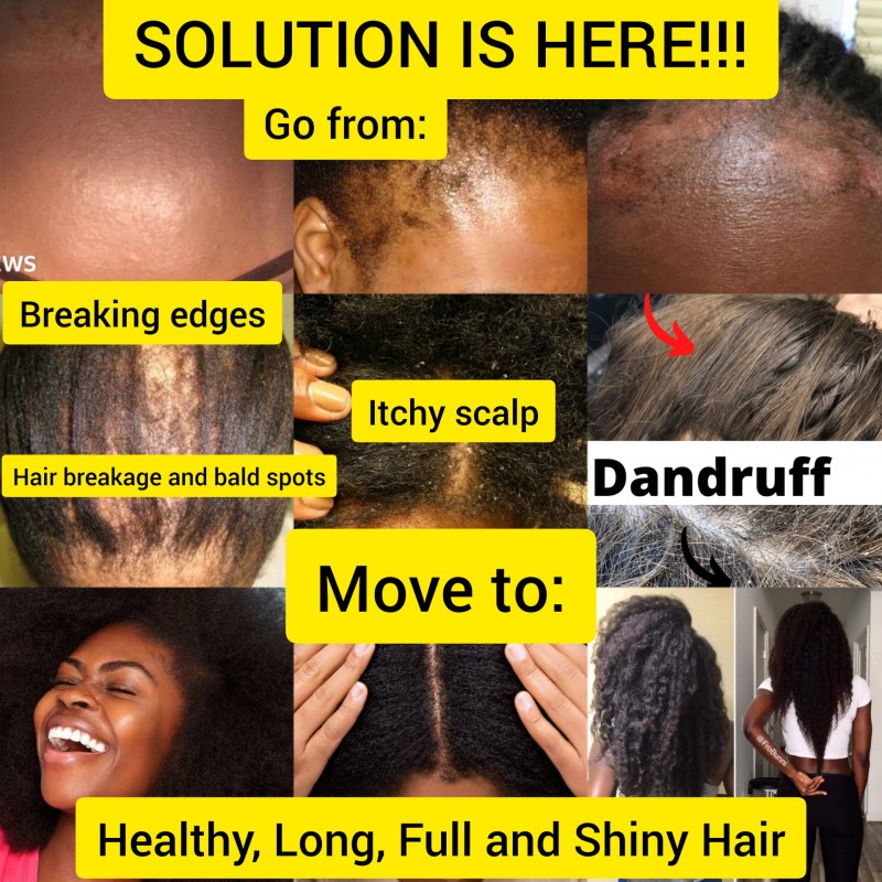 How to Grow Your Natural Hair Fast: With Secret Remedies for Dandruff, Itchy Scalp, and Hair Loss