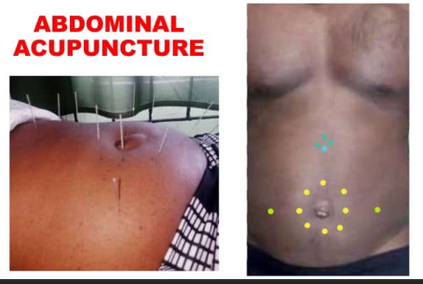 COMPLETE ONLINE MASTERCLASS TRAINING VIDEOS ON ABDOMINAL ACUPUNCTURE