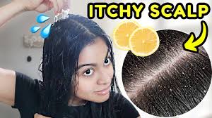Dandruff Herbal Medicine