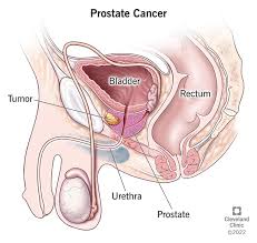 BEST HERBAL REMEDIES FOR PROSTATE CANCER | NATURAL TREATMENT FOR PROSTRATE CANCER.