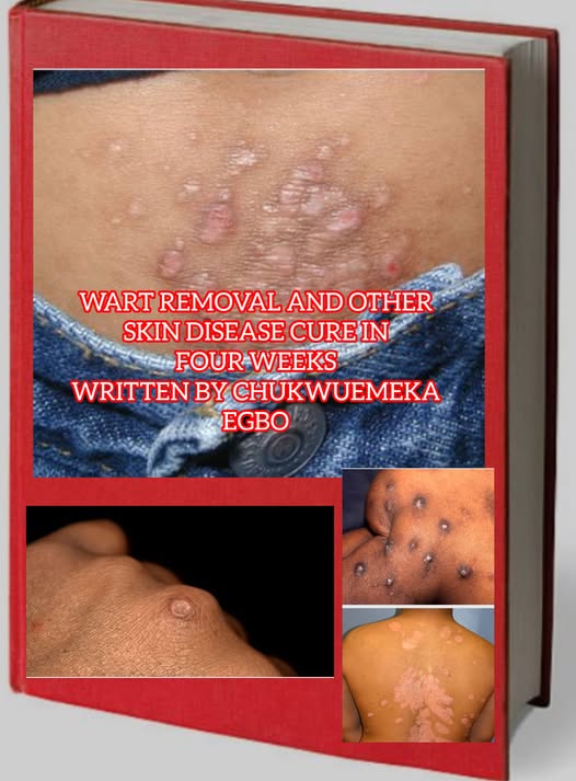 WART REMOVAL AND OTHER SKIN DISEASE CURE IN FOUR WEEKS WRITTEN BY CHUKWUEMEKA EGBO
