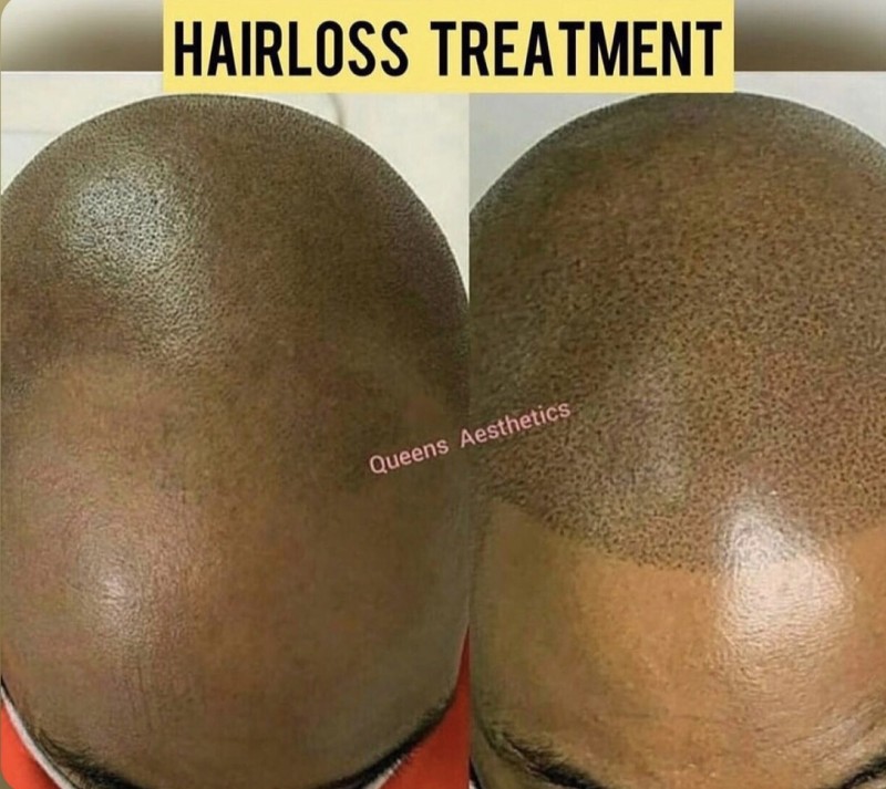 Scalp Micro Pigmentation FREE CONSULTATION